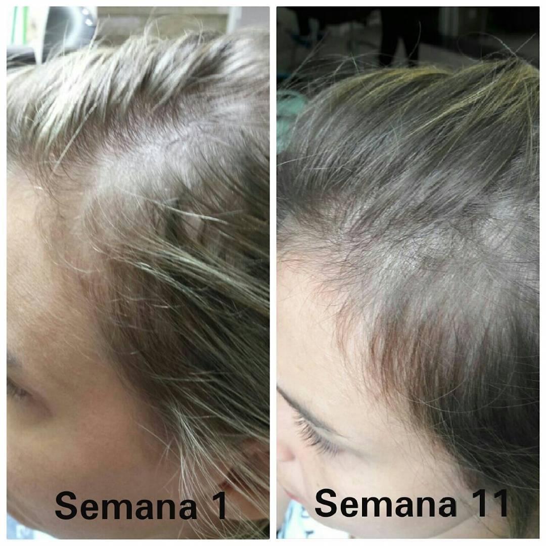 Tratamento para Queda e Crescimento Capilar em Suzano - MS Tricologia Tratamento para Queda e Crescimento Capilar em Suzano - MS Tricologia