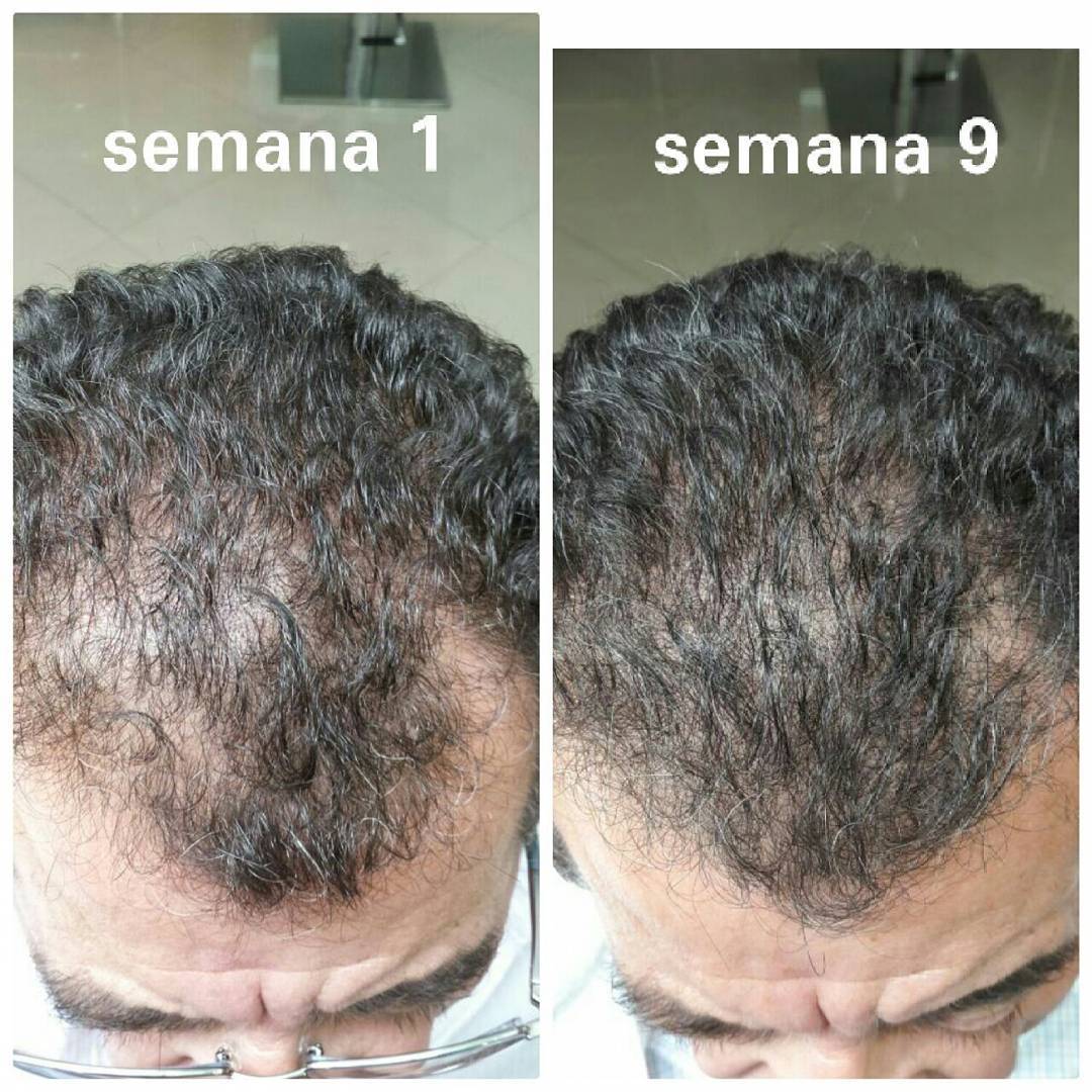 Tratamento para Queda e Crescimento Capilar em Suzano - MS Tricologia Tratamento para Queda e Crescimento Capilar em Suzano - MS Tricologia
