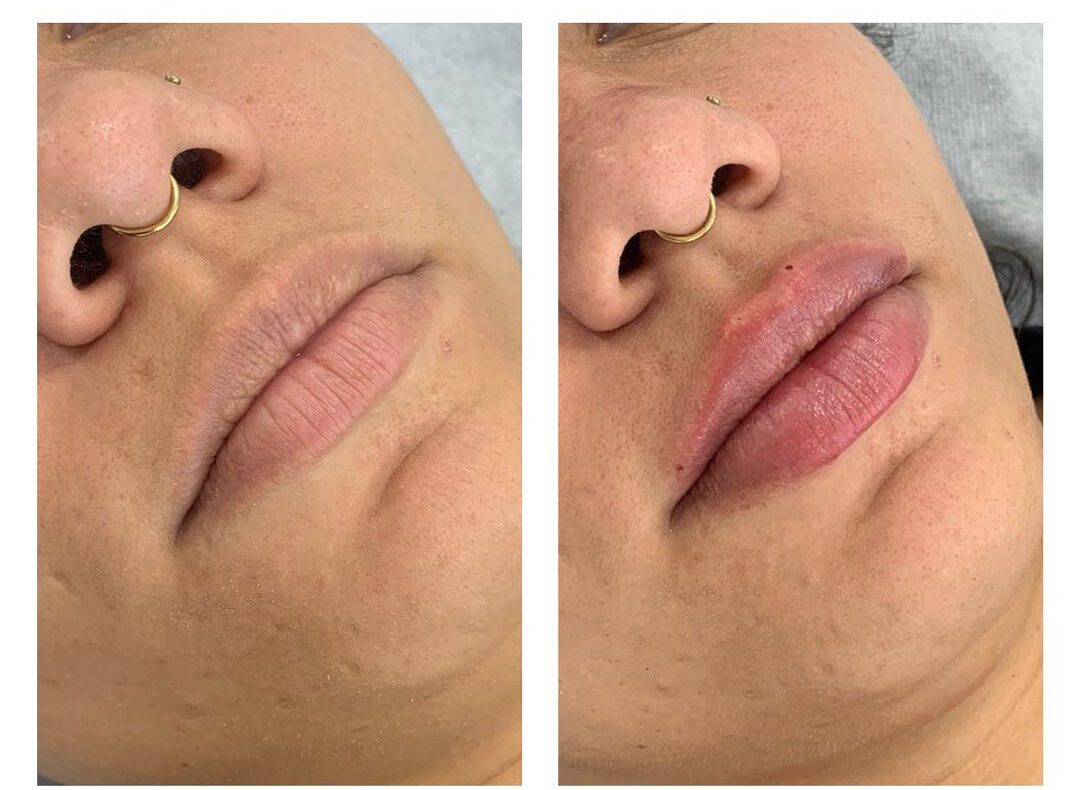Preenchimento Labial em Suzano com Naturalidade | MS Estética Preenchimento Labial em Suzano com Naturalidade | MS Estética