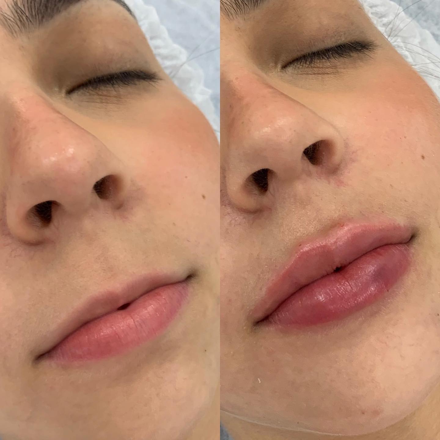 Preenchimento Labial em Suzano com Naturalidade | MS Estética Preenchimento Labial em Suzano com Naturalidade | MS Estética