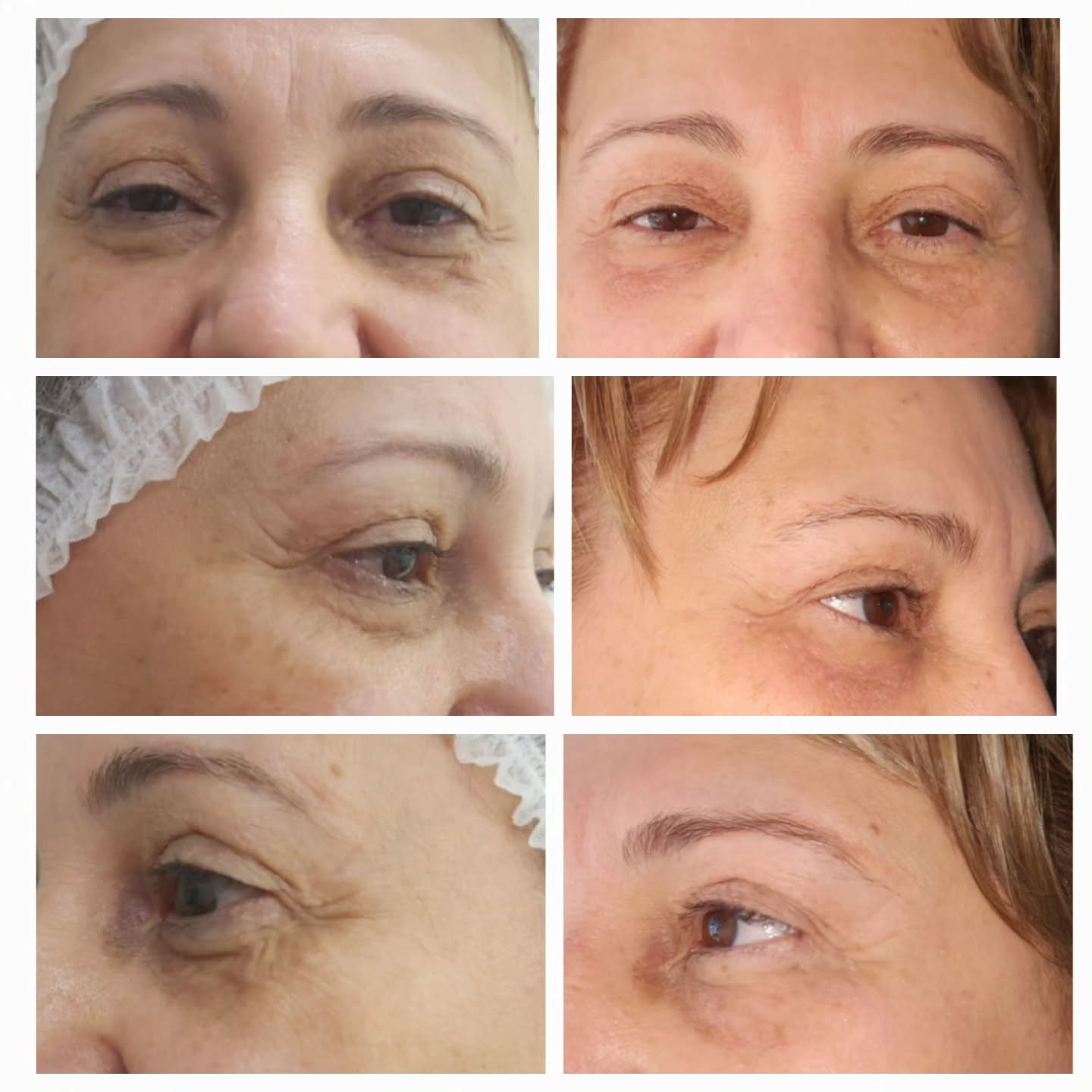 Jato de Plasma em Suzano – SP | Rejuvenescimento na MS Tricologia e Estética Jato de Plasma em Suzano – SP | Rejuvenescimento na MS Tricologia e Estética