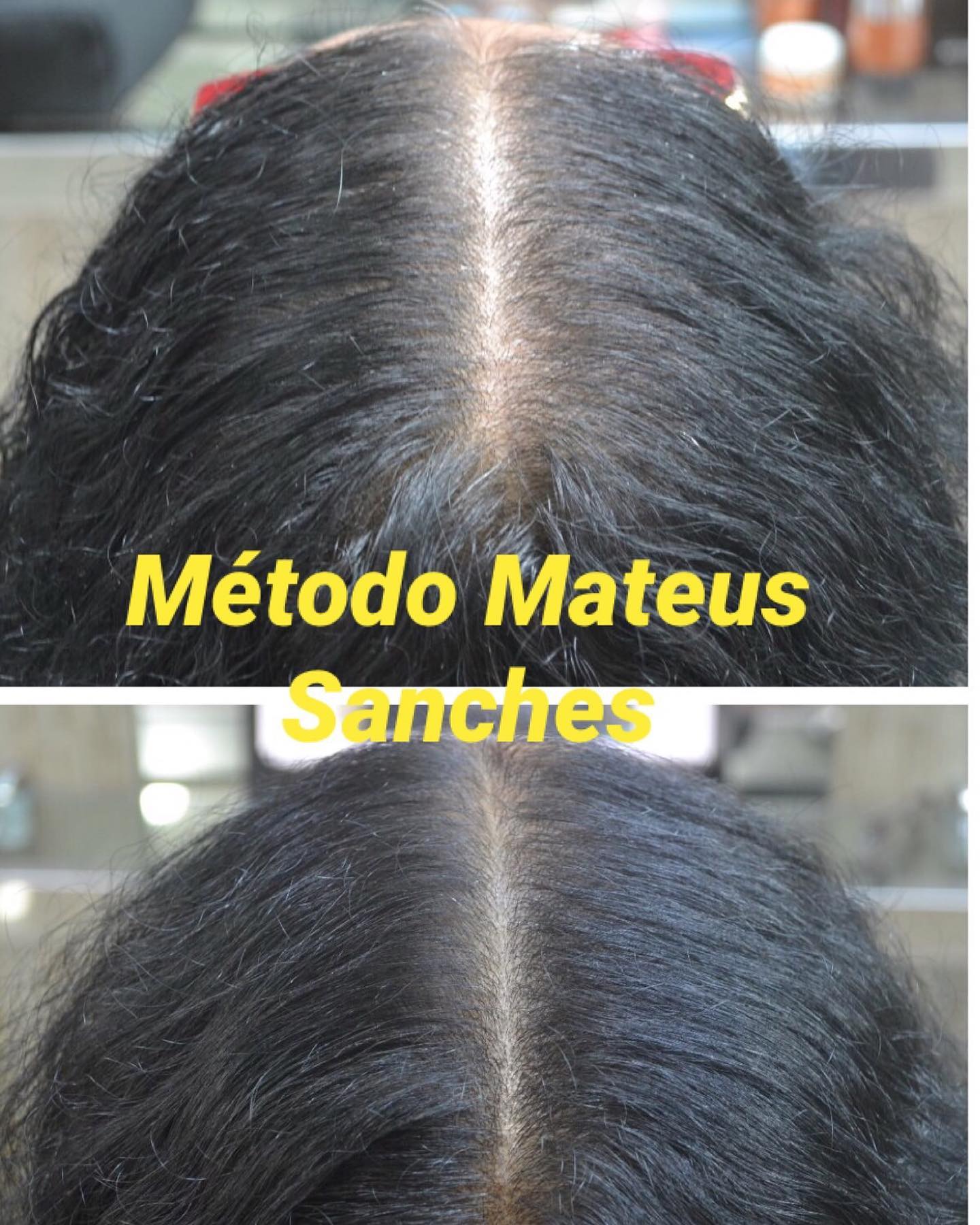 Tratamento para Queda e Crescimento Capilar em Suzano - MS Tricologia Tratamento para Queda e Crescimento Capilar em Suzano - MS Tricologia