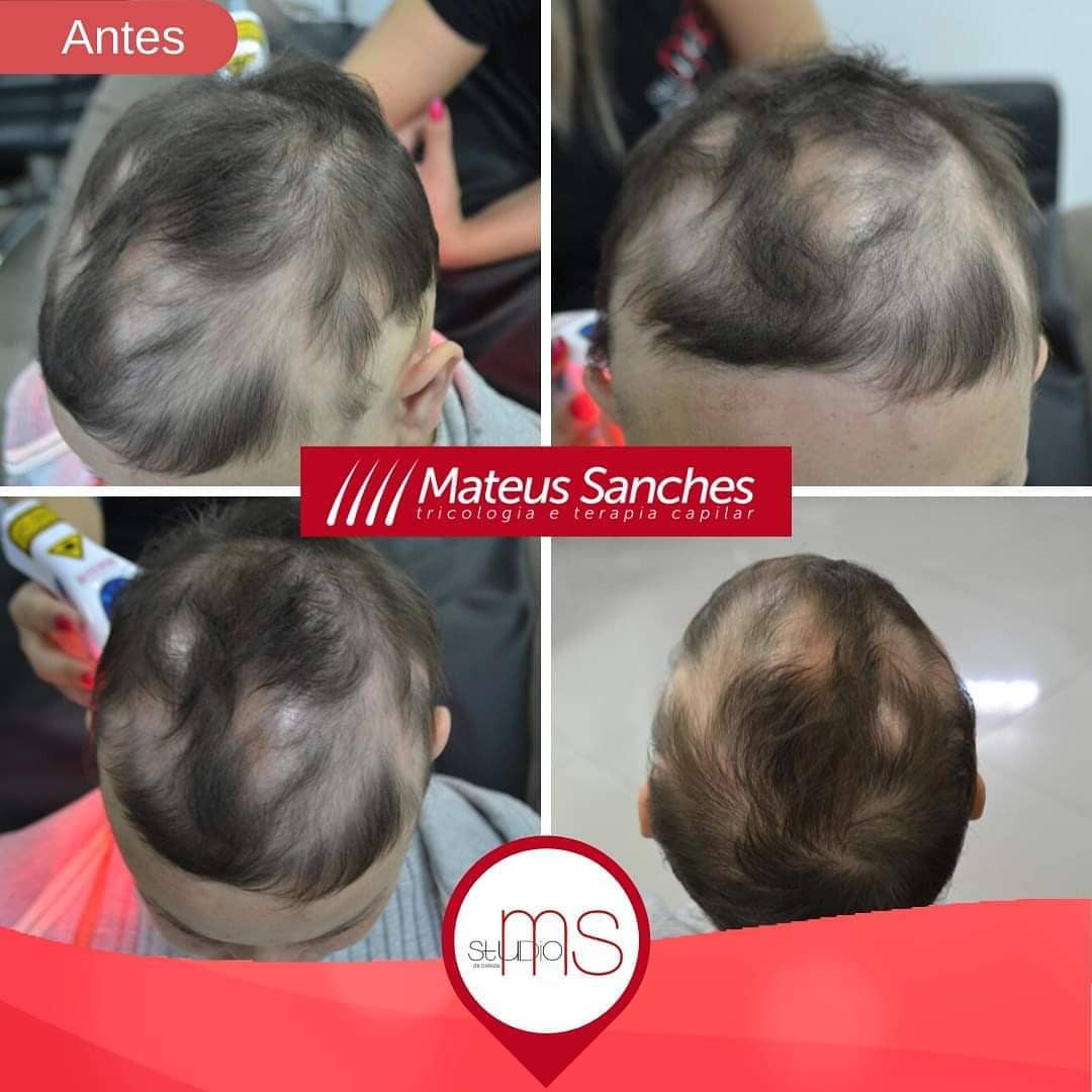 Tratamento para Queda e Crescimento Capilar em Suzano - MS Tricologia Tratamento para Queda e Crescimento Capilar em Suzano - MS Tricologia