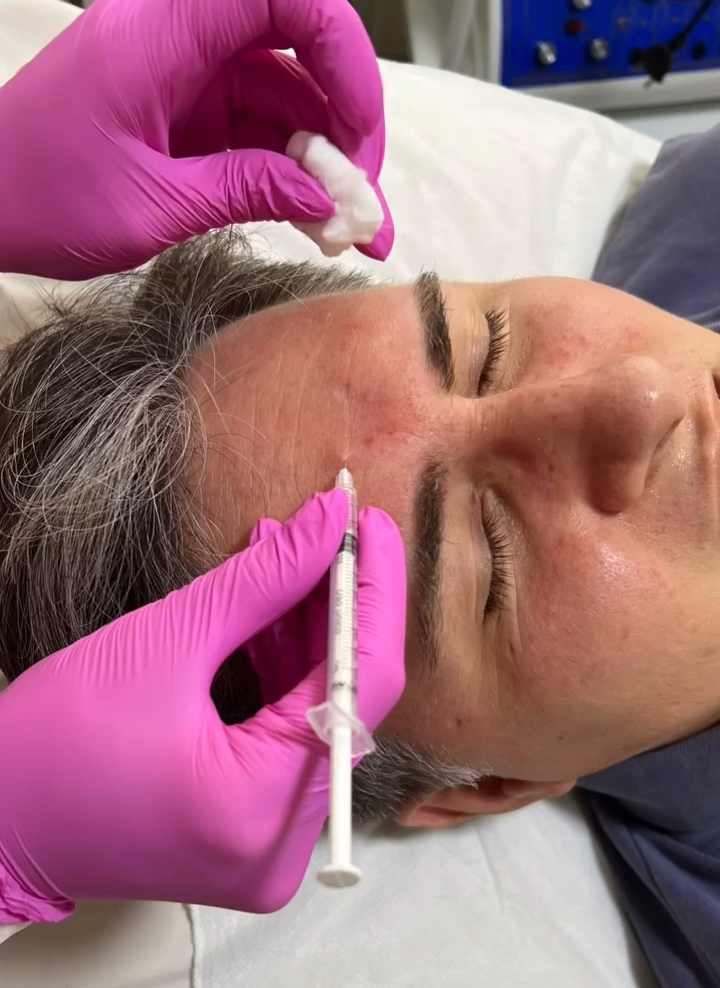 Botox e Ultraformer em Suzano – SP | MS Tricologia e Estética Botox e Ultraformer em Suzano – SP | MS Tricologia e Estética